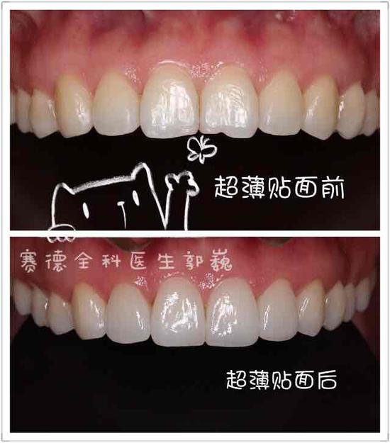 美牙贴面朋友圈文案,美牙贴面朋友圈文案，打造完美微笑，设计导向的数据解析优选版,精细执行计划_Prime27.34.74