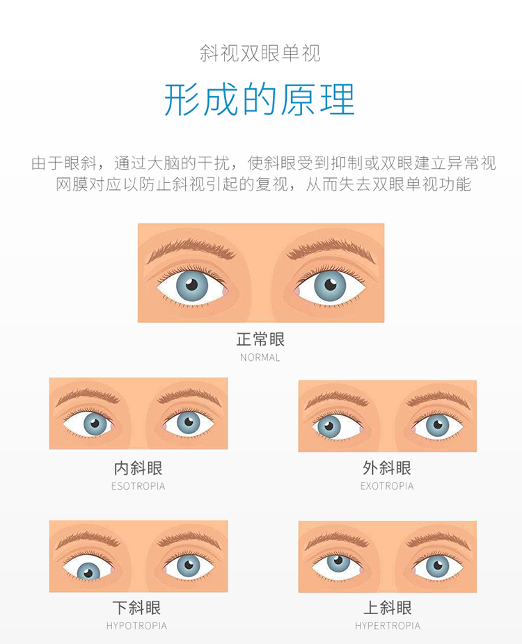 斜视手术术后眼睛多久恢复