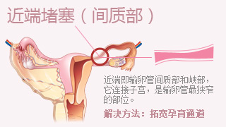 输卵管性不孕症状有那些