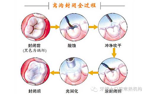 窝沟封闭什么时候做比较合适,窝沟封闭与互动策略评估，探寻最佳时机与实践方法,实地验证方案策略_4DM16.10.81