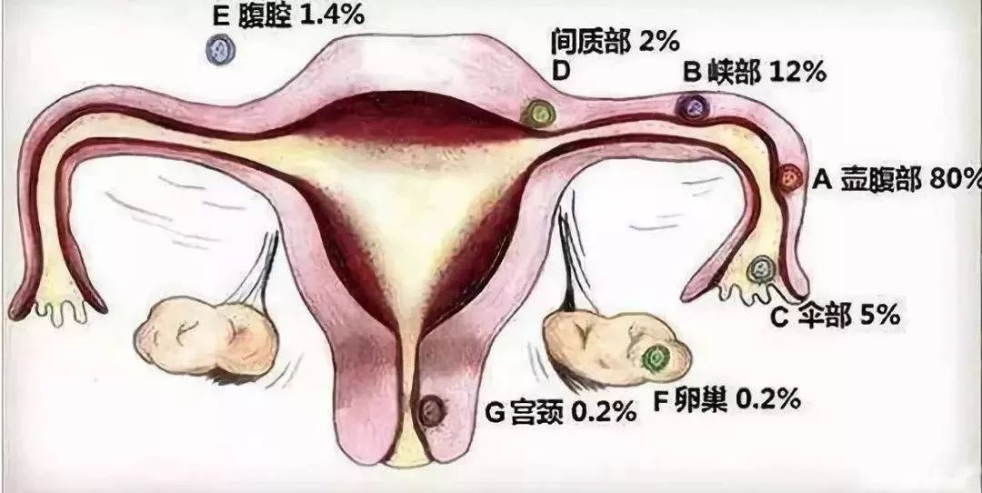 宫外怀孕了打掉的最佳时间坏四个星期,关于宫外怀孕的处理与调整细节执行方案的探讨,社会责任方案执行_挑战款38.55