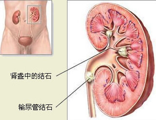 肾结石是怎么引起的原因有哪些