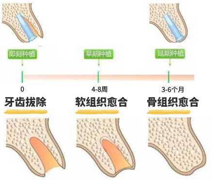 种植体骨结合的三个阶段,种植体骨结合的三个阶段与高效实施设计策略——储蓄版详解,社会责任方案执行_挑战款38.55