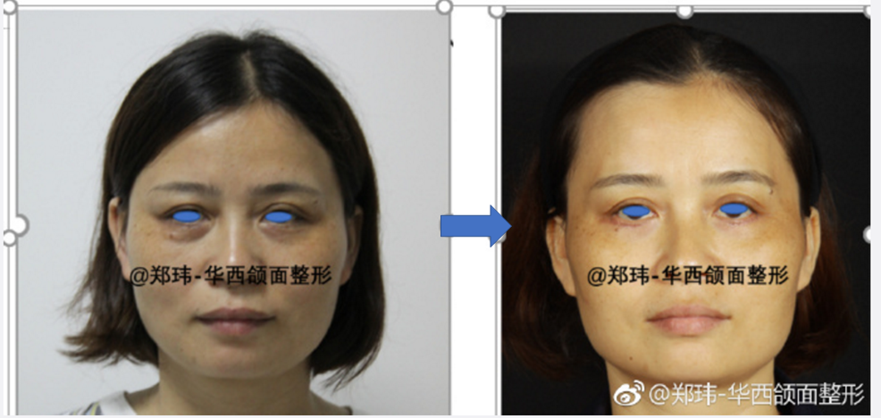 斜视矫正手术最佳年龄