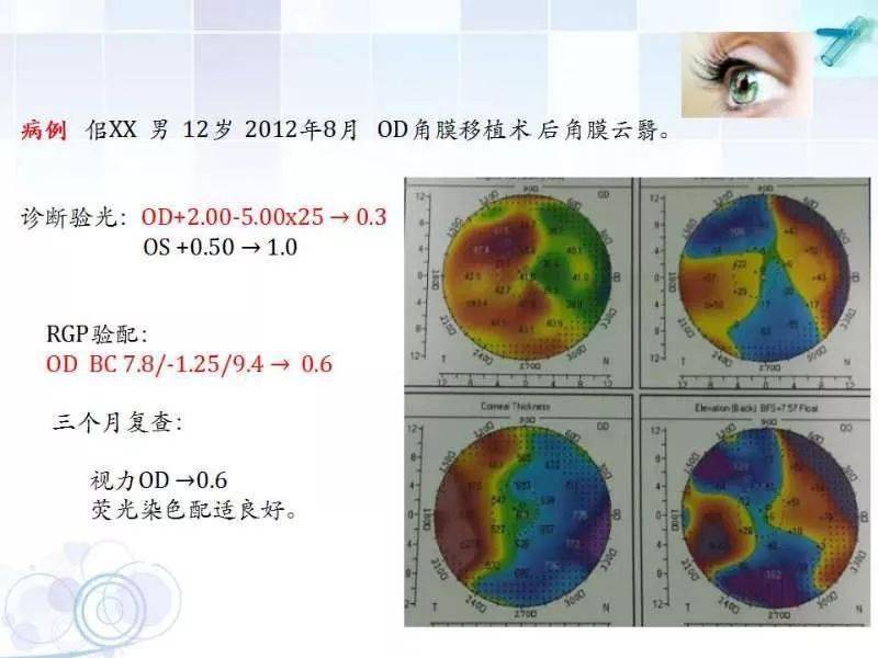 rgp角膜接触镜中的P.A,RGP角膜接触镜中的P.A技术，仿真技术方案实现与定制版的发展,快速计划设计解答_ChromeOS90.44.97