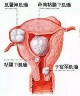 肌壁间子宫肌瘤症状,肌壁间子宫肌瘤的症状及创新治疗计划分析,动态解读说明_vShop76.70.52