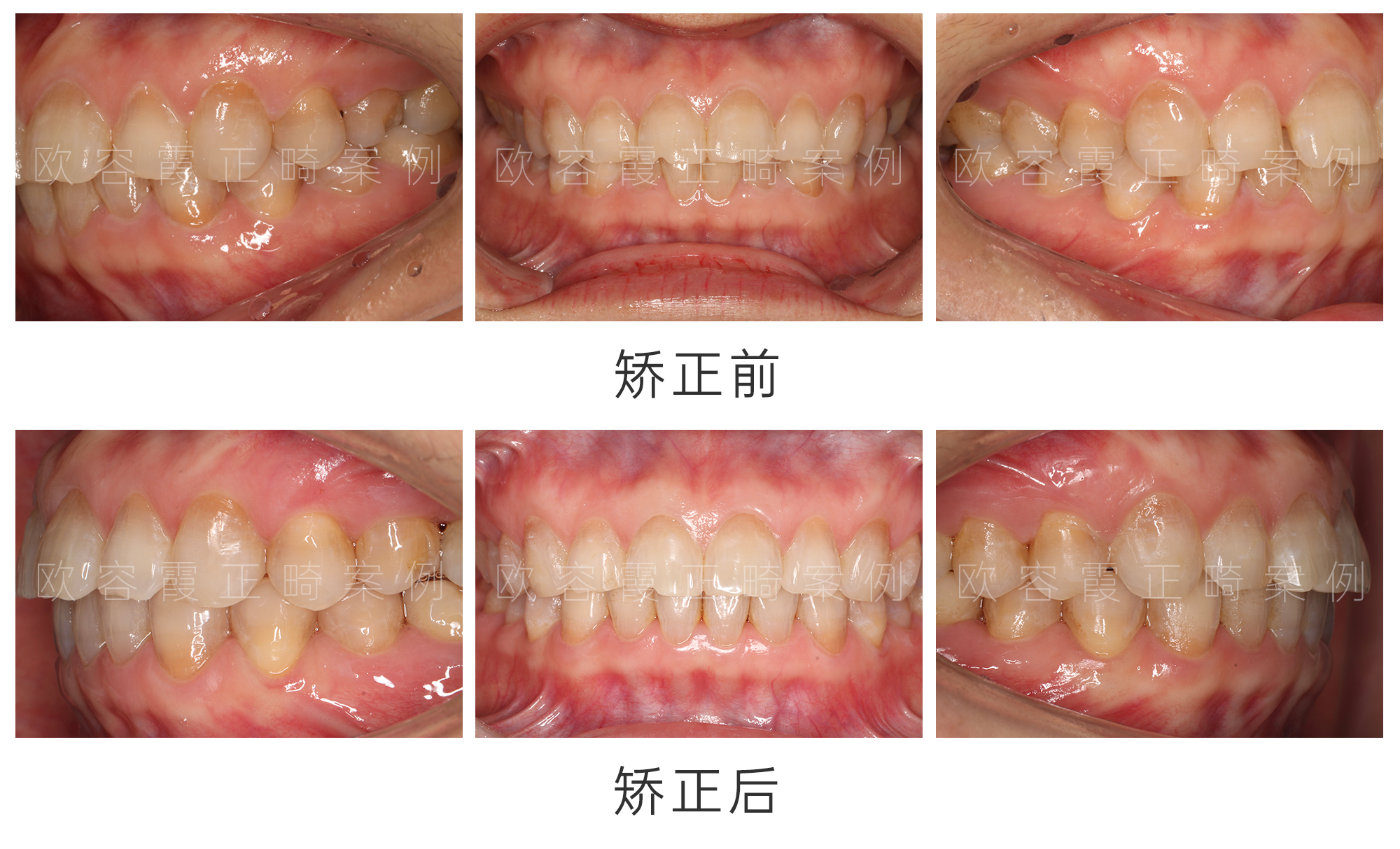 矫牙什么情况需要拔牙,矫牙什么情况需要拔牙及适用性方案解析,高速方案规划_iPad88.40.57